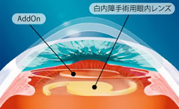 Add-onレンズの種類