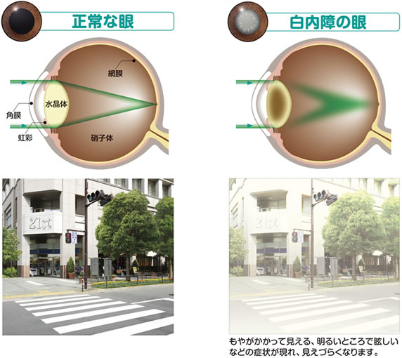 白内障とは cataract surgery