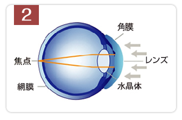角膜の形状を正常な屈折状態にする
