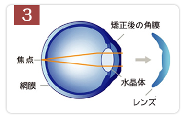 翌朝レンズを外すと視力が改善