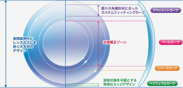 オルソケラトロジー